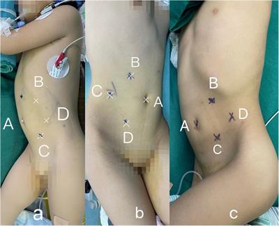 Indocyanine green fluorescence imaging-assisted laparoscopy resection of retroperitoneal tumors in children: case report and literature review